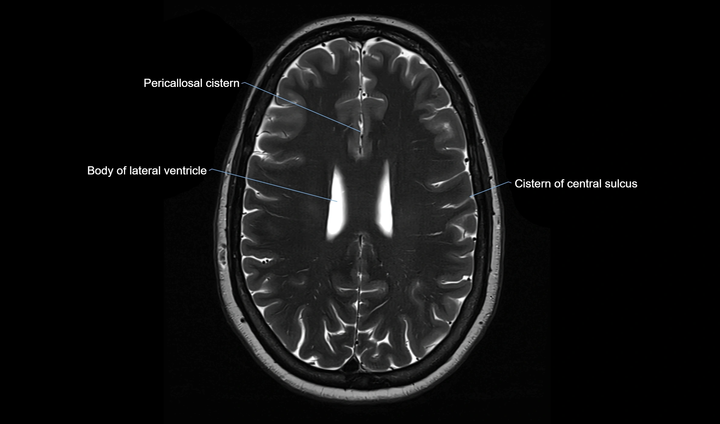 Brain cisterns  and ventricles  axial anatomy 3T MRI image-img-00001-00038.webp